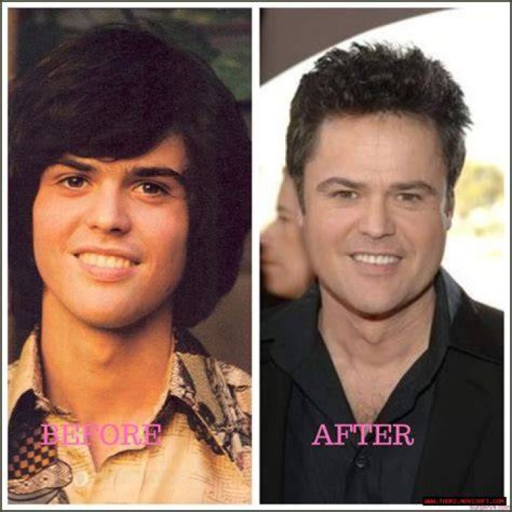 Unveiling Donny Osmond's Plastic Surgery Journey: Discoveries And Insights